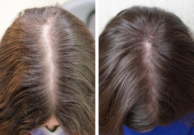 Kirkland Minoxidil 5% Foam Pack 6 x 60 ml - Imagen 3